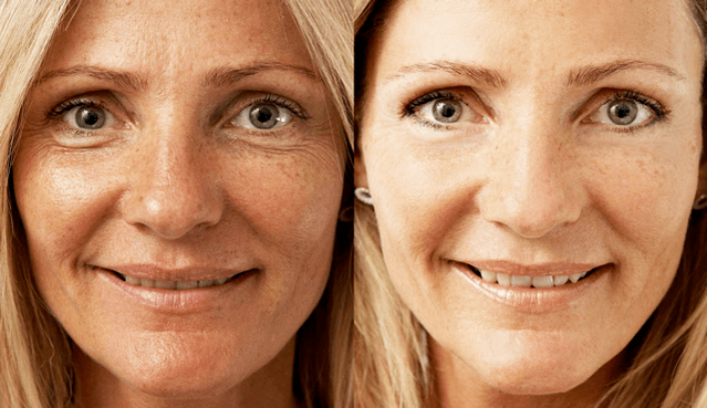 Before and after ELOS units
