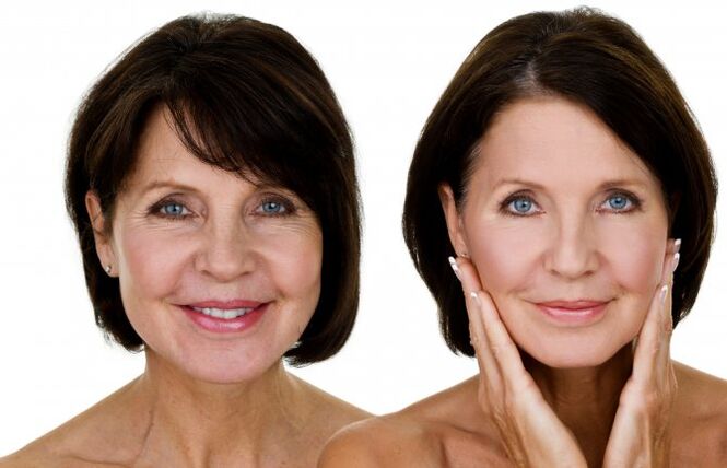 Before and after RF promotion