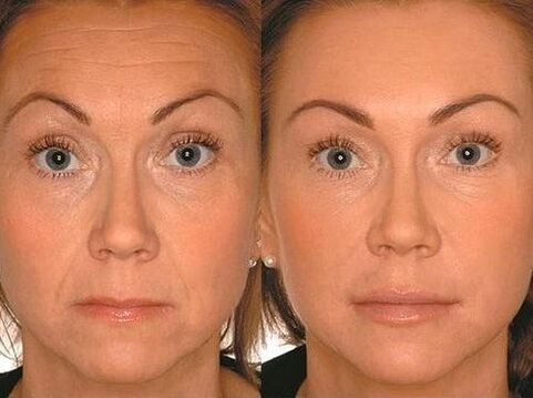 Before and after microcurrent treatment
