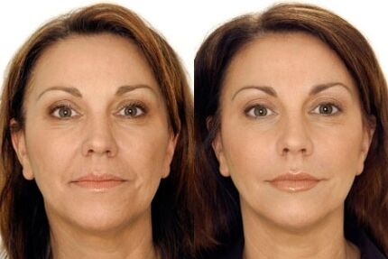 LPG before and after facial massage