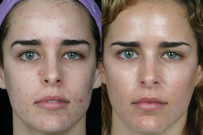 Laser grinding on the face and after skin